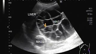 Ultrasound Video showing Hepatic hydatid cyst with a solid mass [upl. by Begga]