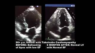 2d Echocardiogram takotsubo Cardiomyopathy [upl. by Adnawal969]