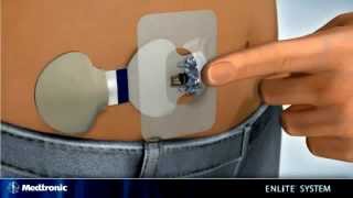 EN Inserting the Enlite Sensor with Paradigm® Veo™ insulin pump Paradigm® Revel [upl. by Oironoh]