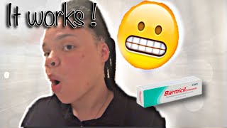 BARMICIL COMPUESTO REVIEW  IT WORKS😱  One week update  KAYY LOVEE [upl. by Eerol]