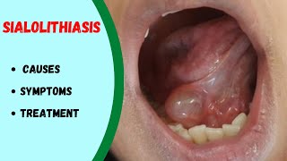 Salivary gland stone  Sialolithiasis  How to remove [upl. by Assilym712]