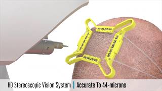 Artas iX Robotic Hair Restoration Procedure [upl. by Kahle]