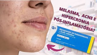 DIPROPIONATO DE BETAMETASONA  ÁCIDO SALICÍLICO PARA MANCHAS NA AXILA VIRILHA ACNE E MELASMA [upl. by Amelita]