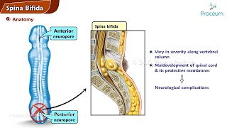 Spina Bifida  Orthopedics Lecture [upl. by Letnahs]