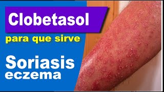 CLOBETASOL para que sirve inflamacion eczema reacciones [upl. by Darius]