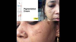 Fix Derma product review  Skarfix tx cream se pigmentation malasma hua kaam [upl. by Heyde]