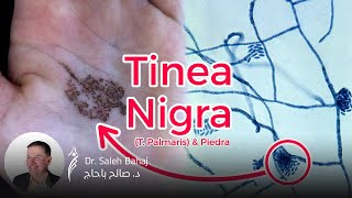 12 Tinea nigra Palmaris amp Piedra [upl. by Stahl]