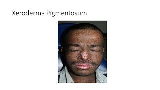 Xeroderma Pigmentosum [upl. by Esinrahc672]