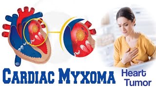 Cardiac Myxoma  Heart Tumor  Symptoms Risk Factors Diagnosis and Treatment [upl. by Bernt]