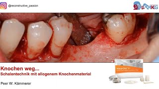 Camlog Webinar – Schalentechnik mit allogenem Knochenmaterial [upl. by Ahsemo]