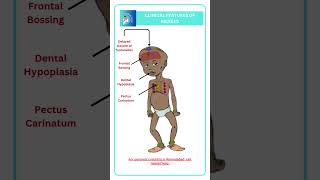 Clinical features of Rickets [upl. by Attezi]