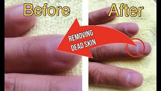 REMOVING DEAD SKIN OFF NAILS INGROWN  PODOLOGIA [upl. by Fachanan]