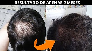 RESULTADO DE APENAS 2 MESES DE TRATAMENTO [upl. by Barcot183]