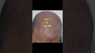 Neo Hair Lotion 30 days Result  Neo Hair Lotion Result Day 1 to Day 30  How to use neo hair lotion [upl. by Akcinat]