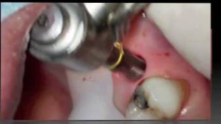 Implant flapless surgery [upl. by Torie162]