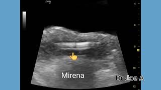 Mirena IUD vs copper T IUD IUCD comparison on ultrasound imaging [upl. by Ellerrehs750]