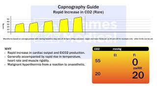 Capnography Waveforms Rapid Increase in EtCO2 [upl. by Faina59]