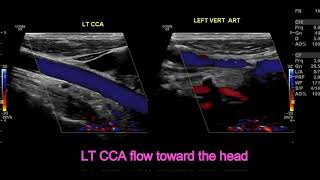 subclavian steal syndrome [upl. by Reffinej]