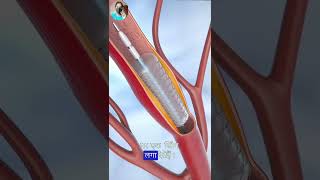 Angioplasty surgery heart process facts shorts viral [upl. by Krell483]