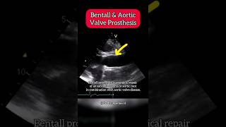 Bentall and aortic Valve Prosthesis on Echocardiography aortic Heart [upl. by Eelrehpotsirhc]