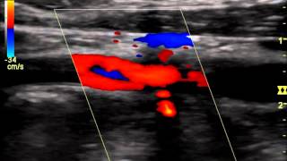 Internal Carotid Occlusion with Recanalizationwmv [upl. by Perla]