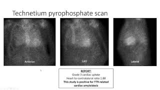 July 2020 Topics in Cardio Oncology Webinar [upl. by Maighdlin]