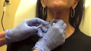 Botox for Platysmal Bands on Neck [upl. by Yam]