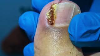 Infected Ingrown Toenail RUINS Toes Overnight [upl. by Yonita]