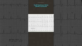 ECG Diagnosis [upl. by Lura]