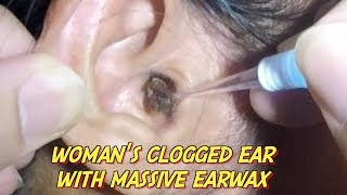 Womans Clogged Ear with Massive Earwax is Finally Removed [upl. by Yttap]