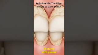 “Periodontitis The Silent Threat to Gum Health”Dentalhealth365 shorts [upl. by Gilcrest]