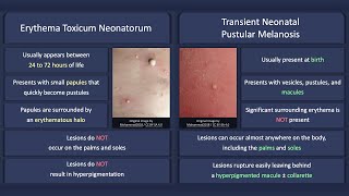 Erythema Toxicum Neonatorum vs Transient Neonatal Pustular Melanosis [upl. by Sew243]