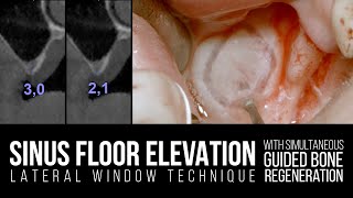 Maxillary Sinus Lift with Lateral Window Technique and Simultaneous GBR [upl. by Avrit]