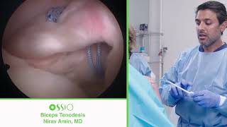 Nirav Amin MD Biceps Tenodesis procedure using OSSIOfiber® [upl. by Barbette]