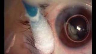 intravitreal TSA injection [upl. by Antonino]