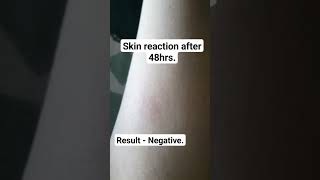 Tuberculin Skin Test [upl. by Junko]