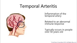 Temporal arteritis [upl. by Yenruoc]