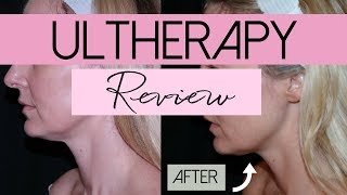 Ultherapy  NonInvasive Face Lift Treatment  Review  BusbeeStyle TV [upl. by Ynaffi]