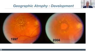 Lecture Dry AgeRelated Macular Degeneration AMD Update New Therapies [upl. by Moffit819]