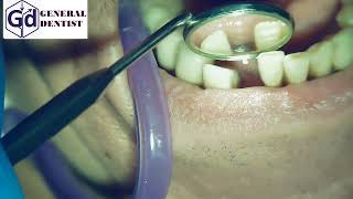 Infiltration anesthesia for insertion gingiva former 42 [upl. by Ainoz]