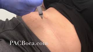 Lipolysis Injections Dr Sharabi PACBocacom [upl. by Ytirahs676]