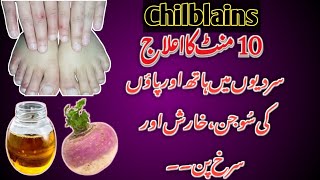 Itchy Toes And Fingers  Chilblains Treatment At Home  How To Treat Swollen Hands In Winters [upl. by Bouchier]