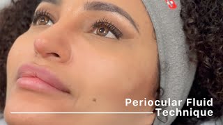 Periocular Fluid Technique complete protocol by Dr Siquier amp Dr Taskesen [upl. by Garv]