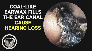 COALLIKE CERUMEN FILLS The Ear Canal Causes Hearing Loss [upl. by Luar]