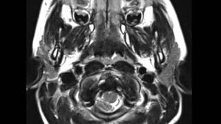 Chiari I Malformation [upl. by Noelle]