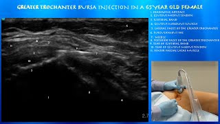 Ultrasound Guided Greater Trochanter Injection by probeultrasound [upl. by Etteyafal]