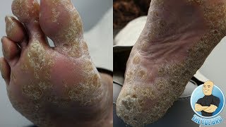 HOW TO TREAT REMOVE FOOT CALLUS  CALLOUS AND CORNS  FOOT HEALTH MONTH 2018 6 [upl. by Munafo]