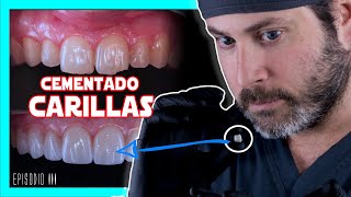 👉COMO se ponen las 𝘾𝘼𝙍𝙄𝙇𝙇𝘼𝙎 𝙙𝙚 𝙋𝙊𝙍𝘾𝙀𝙇𝘼𝙉𝘼 en los dientes Te lo explico FÁCIL  COMPRUEBALO✅ [upl. by Verene177]