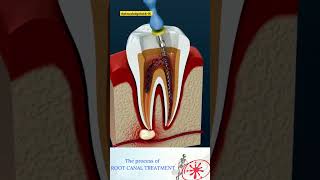 😱shorts 🪥Root Canal Treatment amp Tooth Absces dentalcare viraltrending neet neet2025 neet2026 [upl. by Mehetabel]