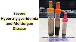 Severe Hypertriglyceridemia and Multiorgan Disease [upl. by Amikehs1]